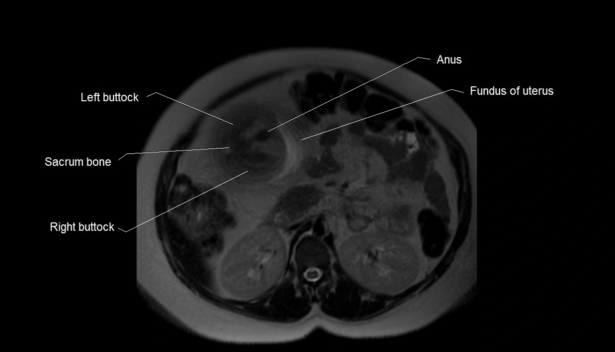 MRI fetal anatomy axial image 2.webp